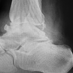 Lateral Ankle Fusion