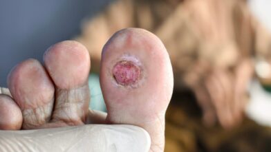 Diabetic foot ulcer on big toe.